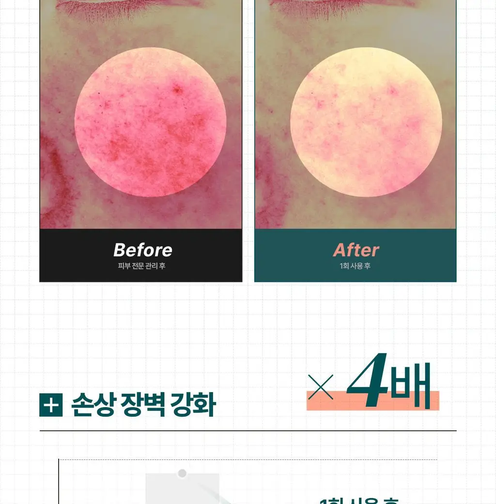 [최모나PICK][리쥬란 제약사_4배속 급속진정] 리쥬더마 EX 리페어링 크림 20g 상세페이지 7